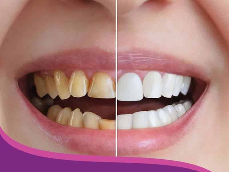 Diseño de sonrisa - Yaz Endodental Consultorio Diseño de Sonrisa - Yaz Endodental Consultorio