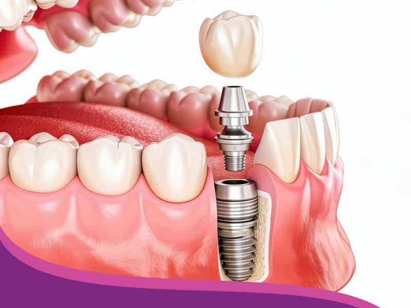 Implantes_dentales Implantes dentales Consultorio Yaz Endodental