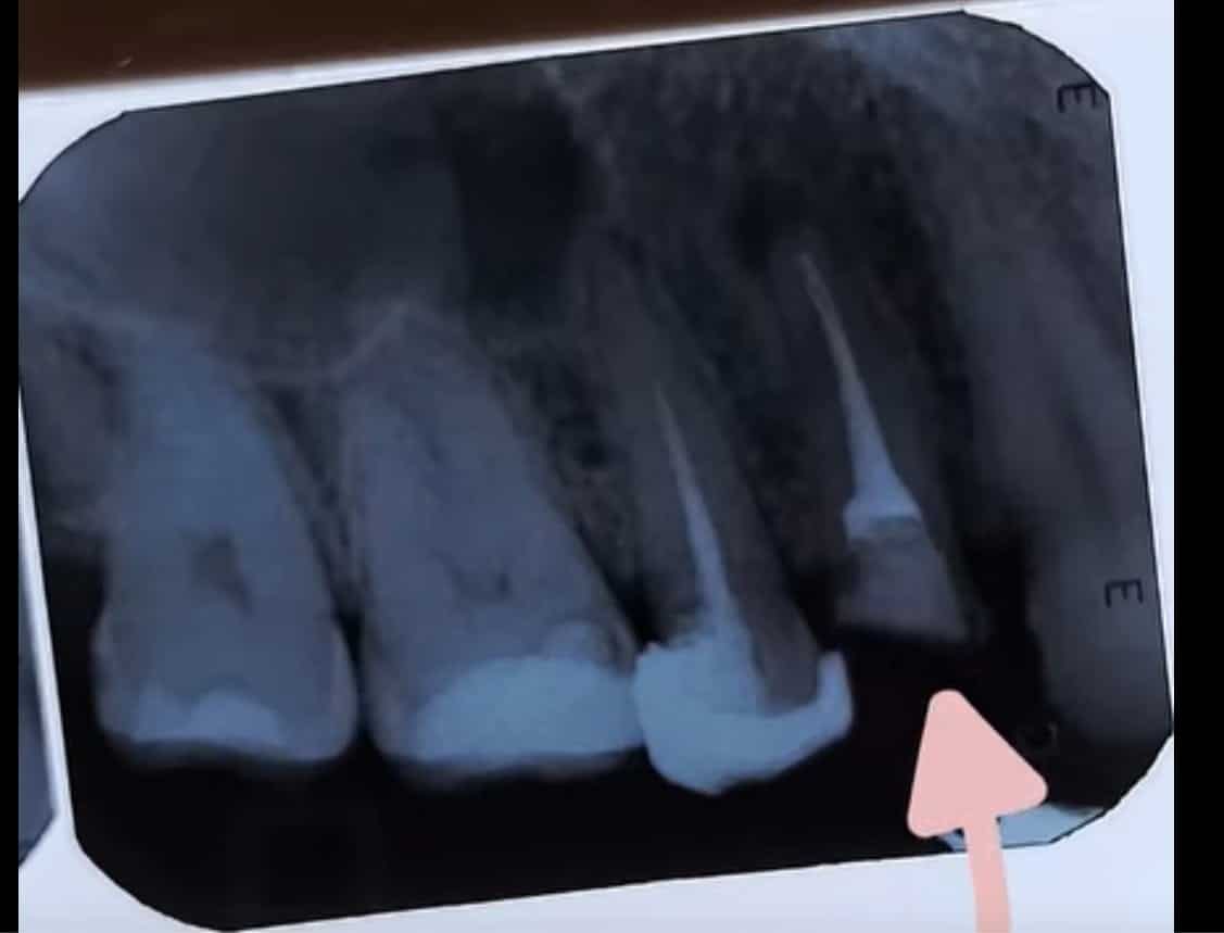 Retratamiento con Bypass Consultorio Yaz Endodental