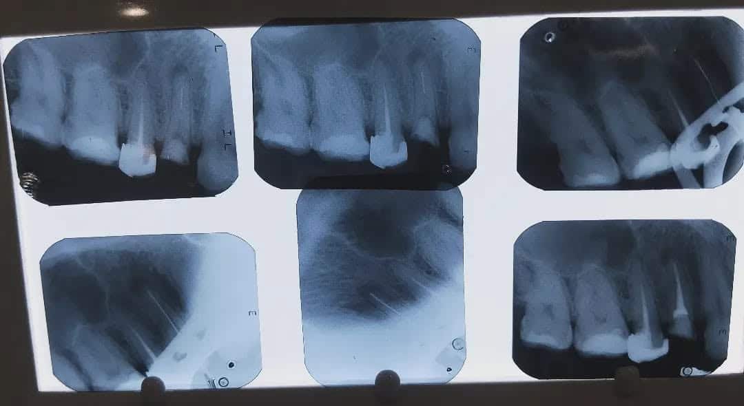 Retratamiento con Bypass 3. Consultorio Yaz Endodental