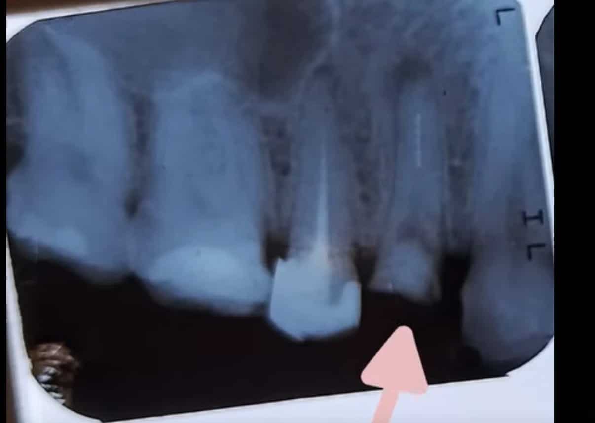 Retratamiento con Bypass 2. Consultorio Yaz Endodental