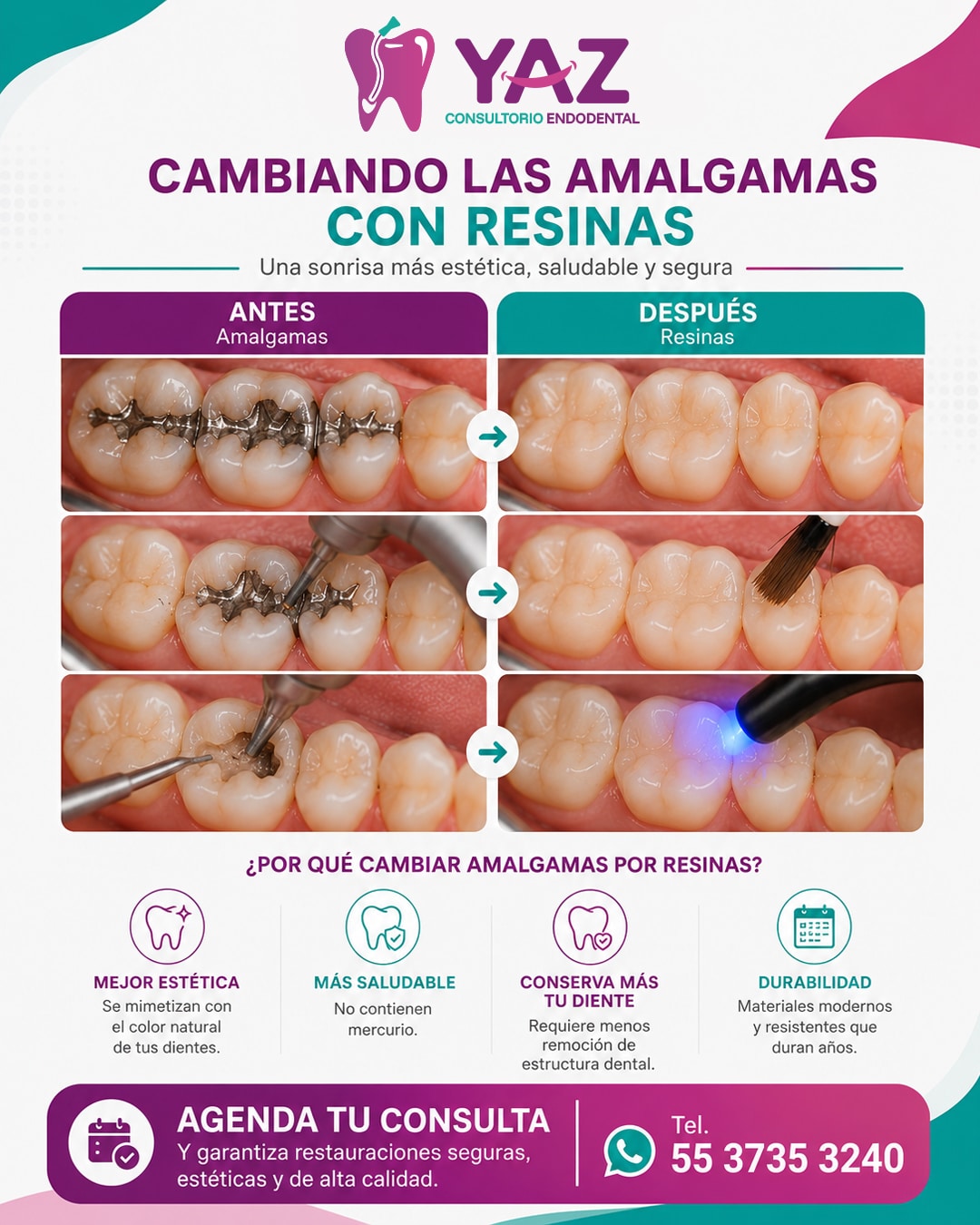 Infografía de amalgamas vs resinas Consultorio Yaz Endodental