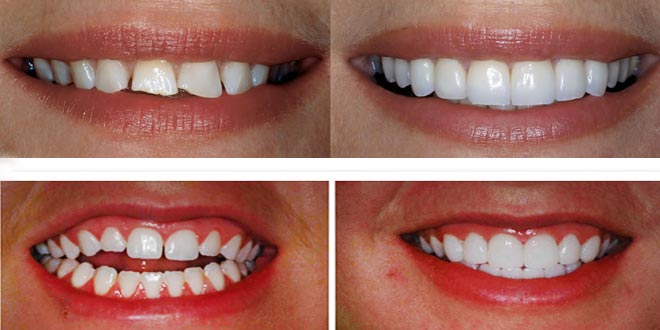 Carillas inyecatdas en cdmx | Yaz Endodental