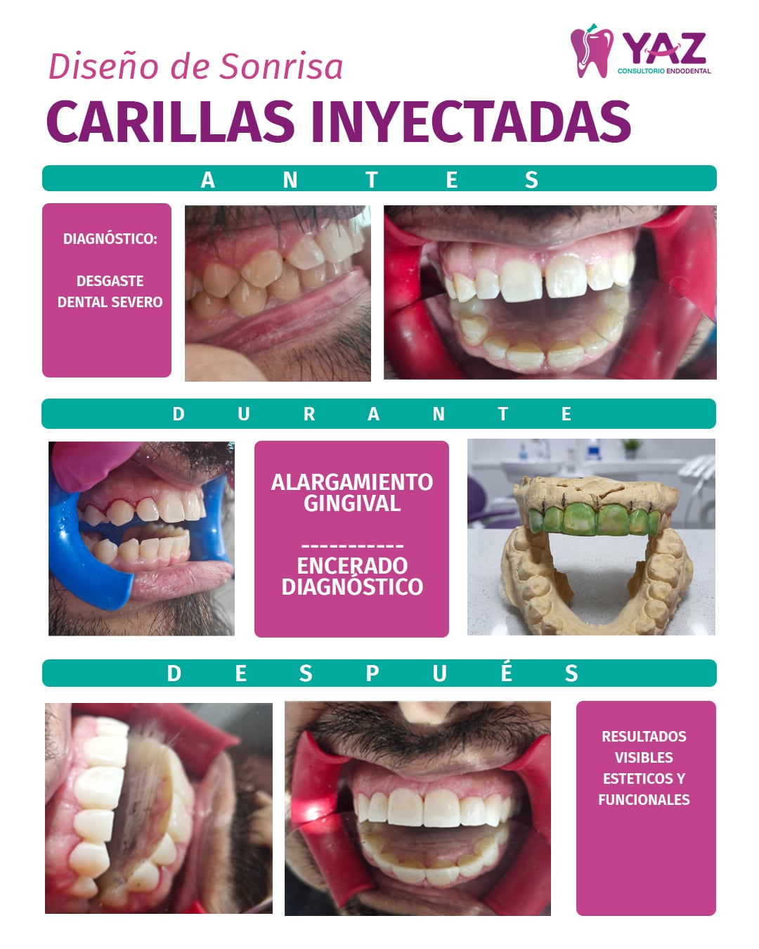 Carillas inyectadas | Consultorio Yaz Endodental