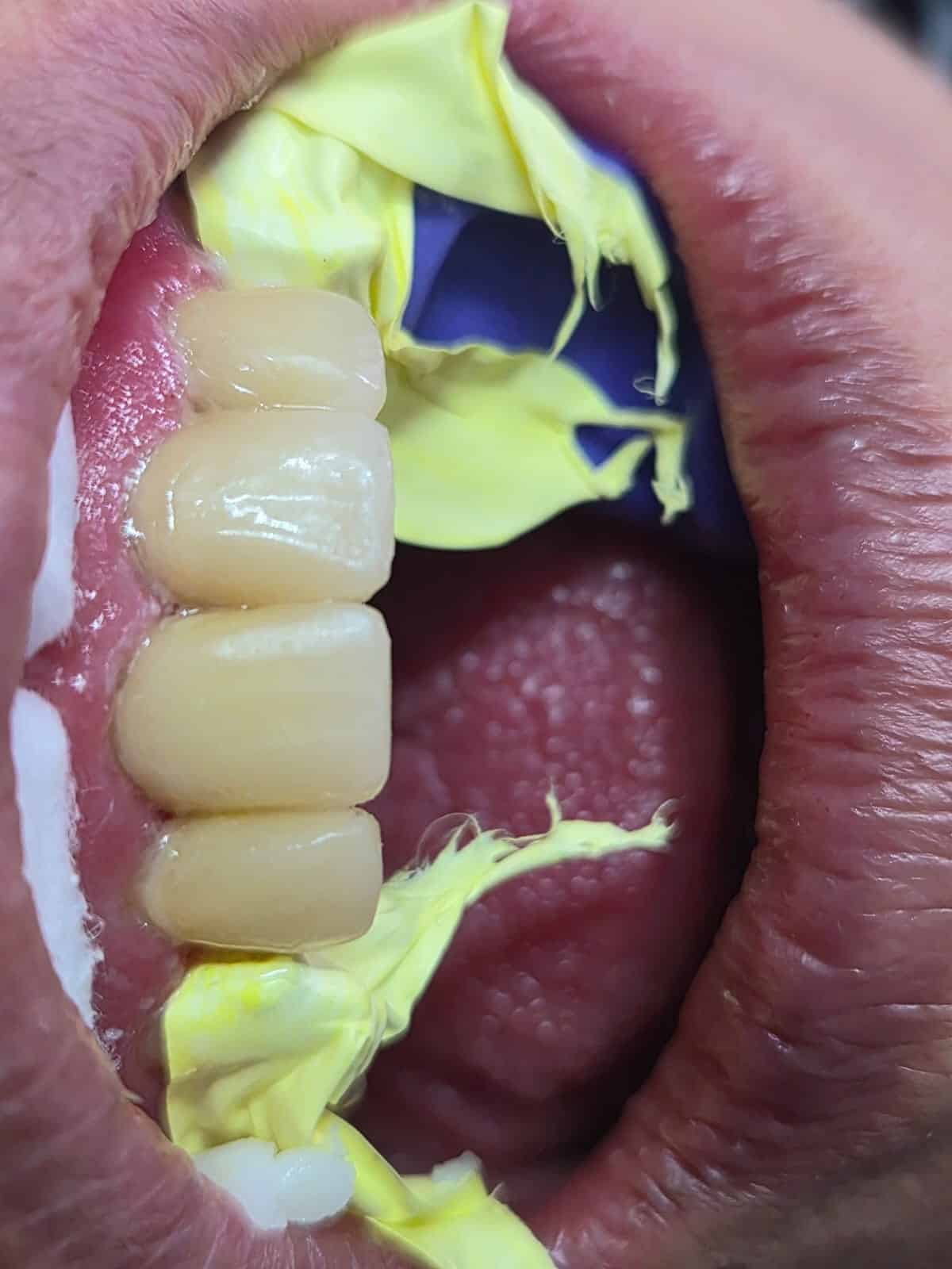 Caso de éxito: Prótesis dental | Consultorio Yaz Endodental Dra Yazmin Arteaga